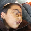 <p>[10328] 12  Operation Cast Lead: Loay Subuh, 10, lost his sight on 7 January 2009, following army bombing of Beit Lahiya. His friend Husam, also 10, was killed in the bombing, and another friend was injured.</p><p>Photo credit: Muhammad Sabah, B'Tselem</p>