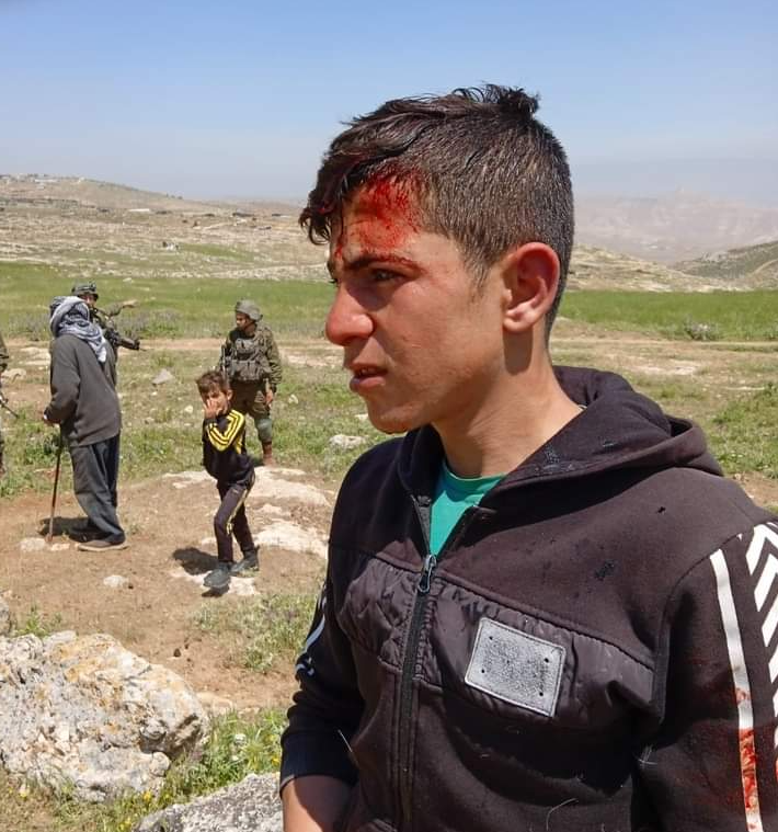 ‘Anan Abu ‘Alia after the attack. Photo courtesy of the shepherds