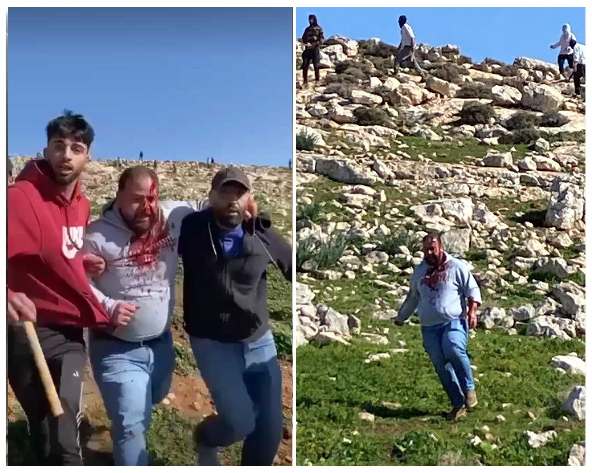 Raji Jaber after being attacked by the settlers. Photo courtesy of the shepherds 