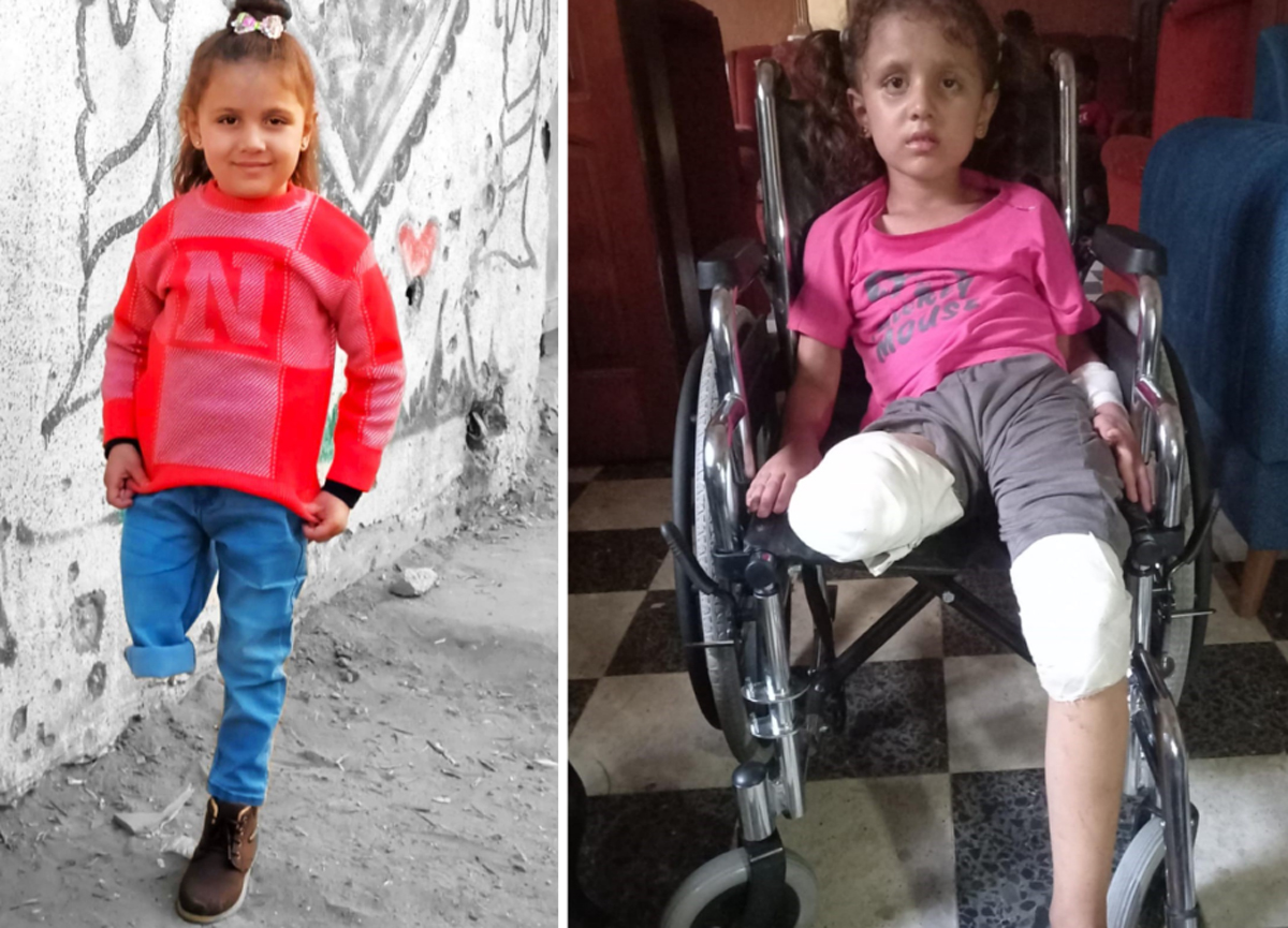 Malak a-Shurafa shortly after her injury and today. Photos courtesy of the family