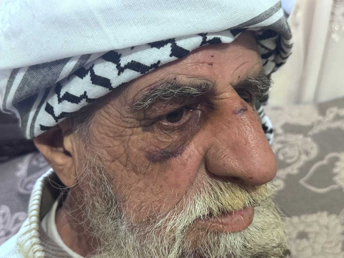 محمد عواودة بعد الاعتداء عليه. تصوير: محمد رمانة، بتسيلم