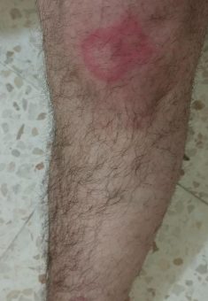 Marks the soldiers' beating left on Abu Sha'ban's leg. Photo courtesy of Abu Sha'ban 