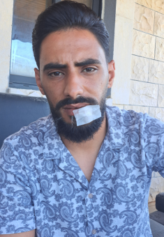 מוחמד ערמאן לאחר תקיפתו בידי מתנחלים. צילום: עבד אל-כרים סעדי, בצלם
