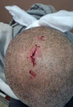Bilal Mahariq’s head wound. Photo courtesy of the family