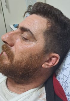הפצע באוזנו של פרעונייה. צילום: סלמא א-דיבעי, בצלם