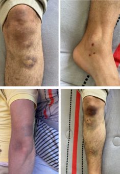 الكدمات على جسد "م. ع.". تصوير: محمد رمانة، بتسيلم 