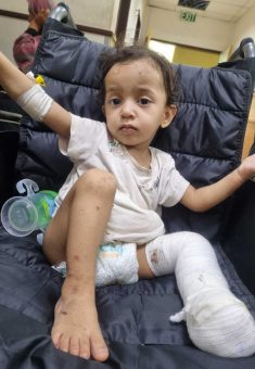 Misk a-Daqi after her foot was amputated. Photo courtesy of the family