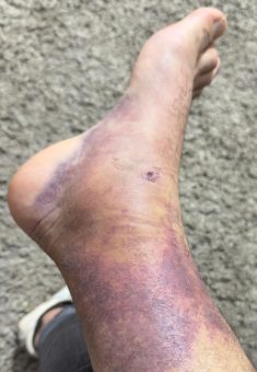 Wahaj Bani Moufleh’s leg after the attack. Photo courtesy of Bani Moufleh 