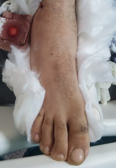The bullet wound in I.A.’s leg. Photo: Salma a-Deb’i, B’Tselem 