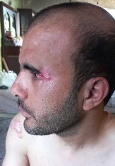 حرق بجانب عين محمد أبو طويلة والإصابة في عينه. صورة قدمها الشاهد مشكورًا