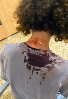 An activist beaten by the settlers. Photo: Torat Tzedek