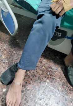 The bullet hole in Ibrahim ‘Abdallah’s foot. Photo: Salma a-Deb’i, B’Tselem 