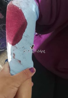 كدمات على أجساد الناشطات. صورة قدمتها الناشطات مشكورات