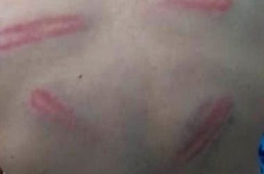 סימני המכות על גבו של פריד אל-עריד לאחר תקיפתו בידי המתנחלים. התמונה באדיבות המשפחה