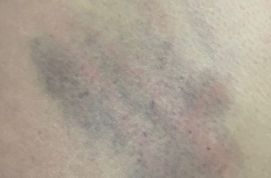 كدمات على أجساد الناشطات. صورة قدمتها الناشطات مشكورات