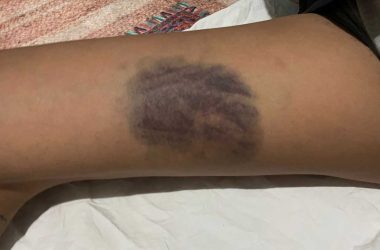 كدمات على أجساد الناشطات. صورة قدمتها الناشطات مشكورات