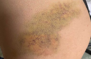 كدمات على أجساد الناشطات. صورة قدمتها الناشطات مشكورات