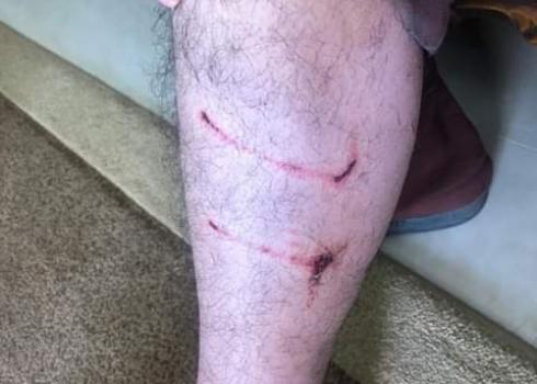 Isma'il Hlaiqah's leg, after a dog bit him