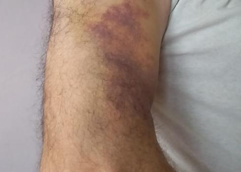 ‘Abdallah Salman’s injured hand after a settler attack in Far’ata, 29 April 2020