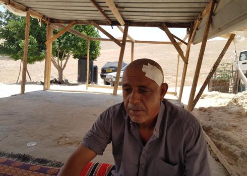 מוחמד כעאבנה שהוכה בראשו על ידי מתנחל. ואדי אל-קלט, 21.6.20. צילום: עאמר עארורי, בצלם