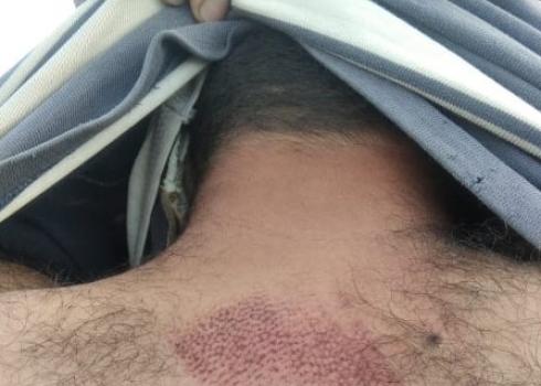 The bruise on Subhi Shalaldeh’s back after a settler ran him over with an ATV. al-Qanub, 21 Dec. 2020
