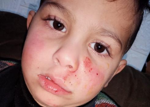 Jad Suaftah (3), who was hit by a stone a settler threw at the car he was traveling in, Givat Assaf, 21 Jan. 2021. Photo: Suaftah family