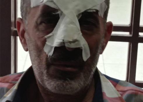 ‘Abd a-Nasser Dmeidi after his nose was bandaged. 