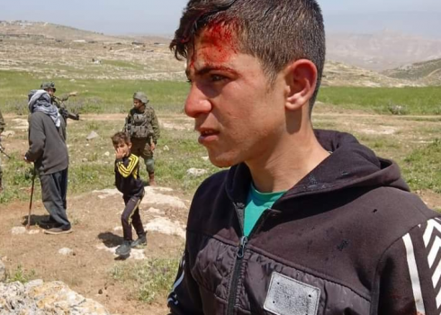 ‘Anan Abu ‘Alia after the attack. Photo courtesy of the shepherds