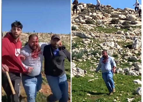 Raji Jaber after being attacked by the settlers. Photo courtesy of the shepherds 