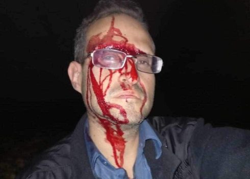 The activist injured by settlers who assaulted him. Photo courtesy of Jordan Valley activists, 4 Dec.2023 