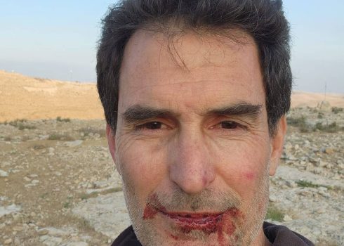 The Israeli activist after he was beaten by the settler. Photo courtesy of the activist