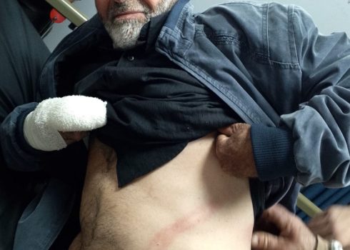 Mahmoud Hammad in the hospital, showing his bruises. Photo: Mohammad Romaneh, B’Tselem, 31 Dec. 2024