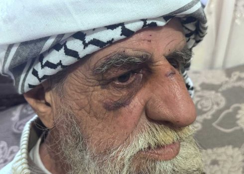 Muhammad ‘Awawdeh after the assault. Photo: Mohammad Romaneh, B’Tselem