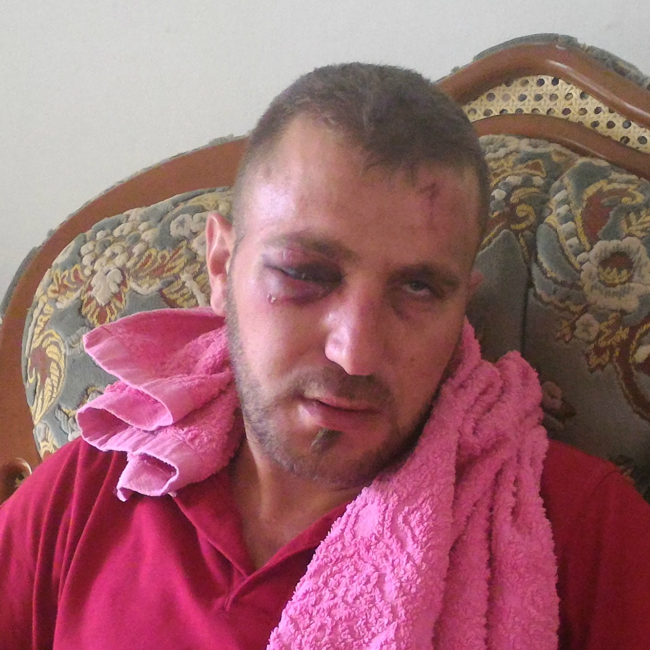 عباس برغوثي الذي أصيب في عينه من ضربات الجنود. تصوير: اياد حداد، بتسيلم. 24.7.17.